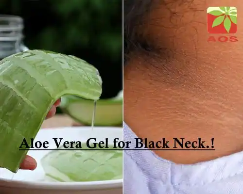 Aloe Vera Gel for Black Neck