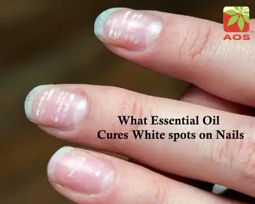 What Essential Oil Cures White spots on Nails